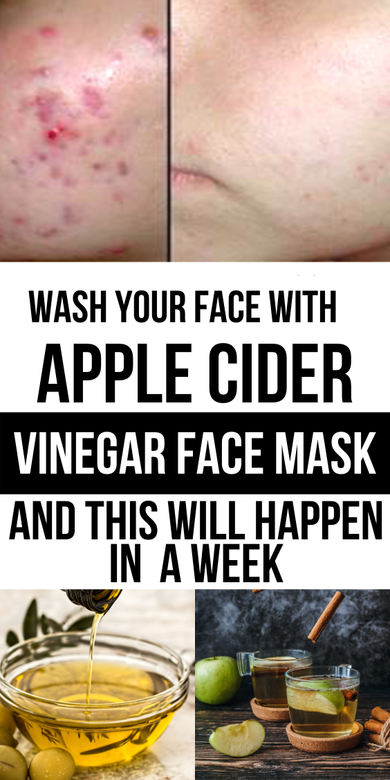 Apple Cider Vinegar Face Mask 5 Times Daily And See The Result Within A Week