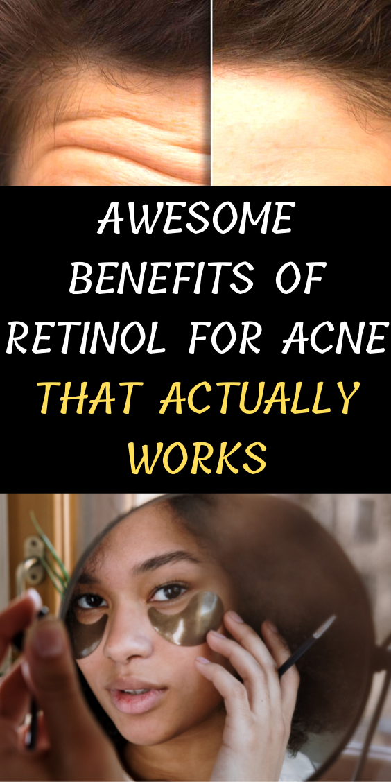 Awesome Benefits Of Retinol For Acne That Actually Works