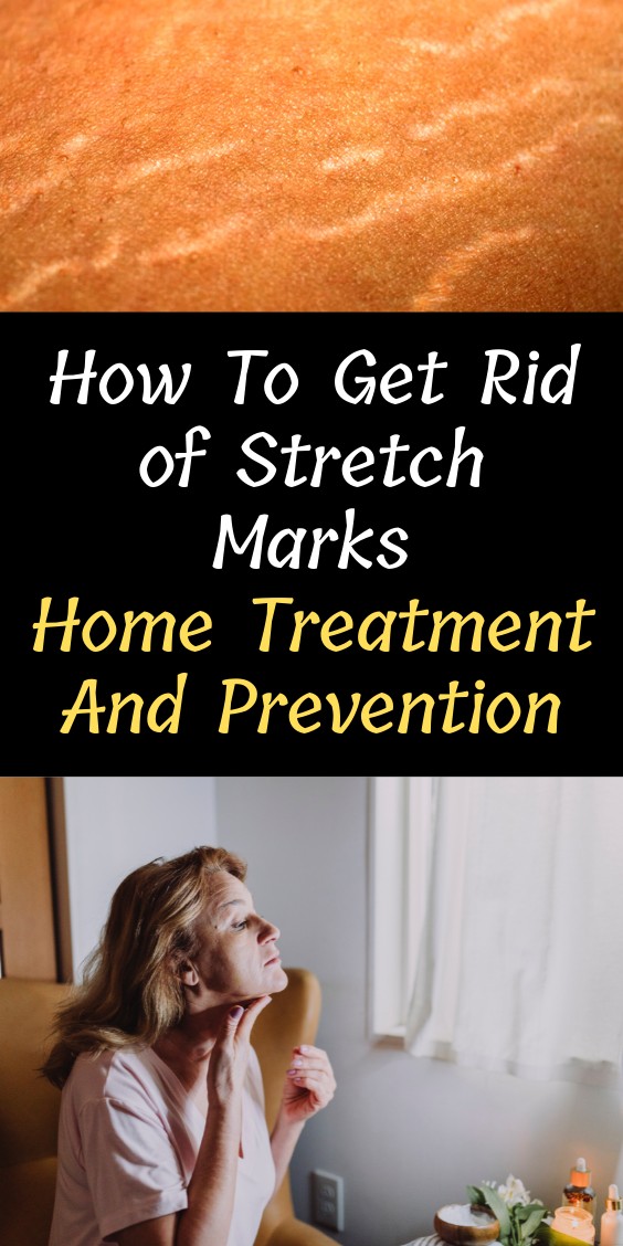 How To Get Rid Of Stretch Marks