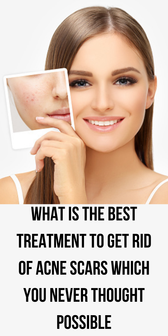 what-is-the-best-treatment-to-get-rid-of-acne-scars