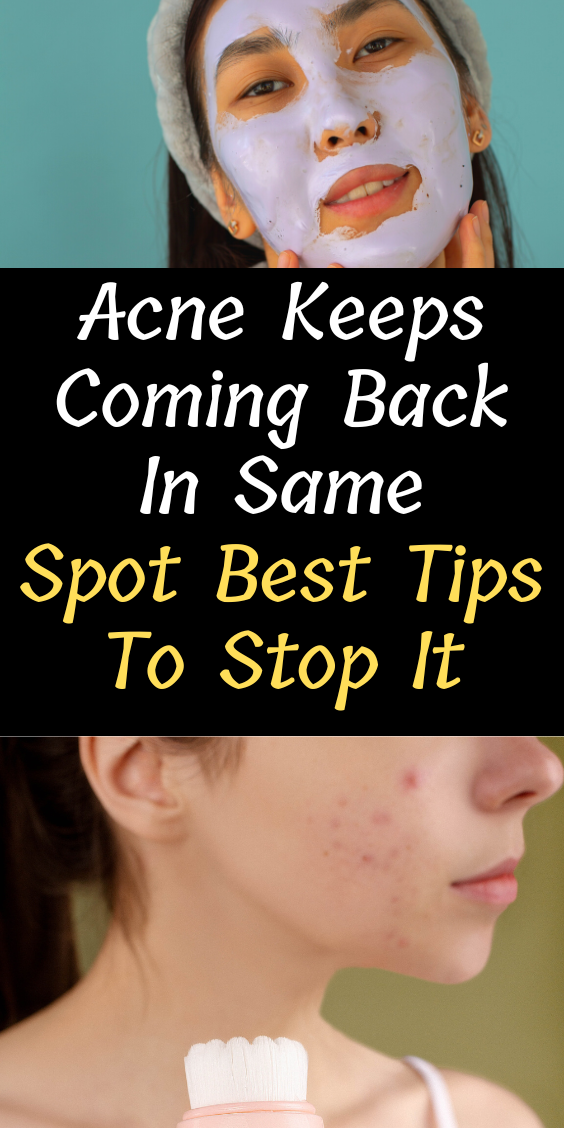 acne-keeps-coming-back-in-same-spot