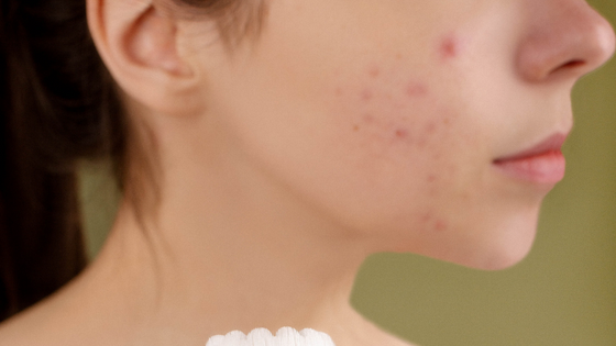acne-keeps-coming-back-in-same-spot